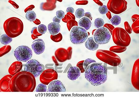 Stock Image - Acute lymphoblastic leukaemia smear, illustration. Fotosearch