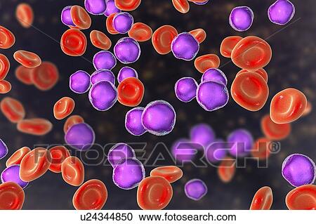 Acute lymphoblastic leukaemia smear, illustration View Large Photo Image Stock Image - Acute lymphoblastic leukaemia smear, illustration. Fotosearch