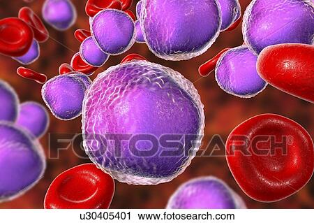 Acute lymphoblastic leukaemia smear, illustration View Large Photo Image Stock Image - Acute lymphoblastic leukaemia smear, illustration. Fotosearch