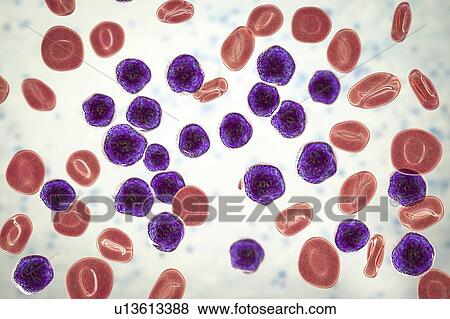 Stock Photo - Acute lymphoblastic leukaemia smear, illustration. Fotosearch