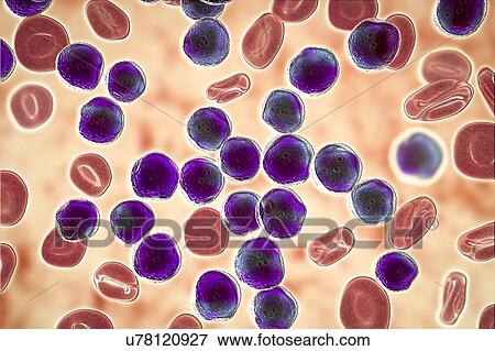Stock Photo - Acute lymphoblastic leukaemia smear, illustration. Fotosearch