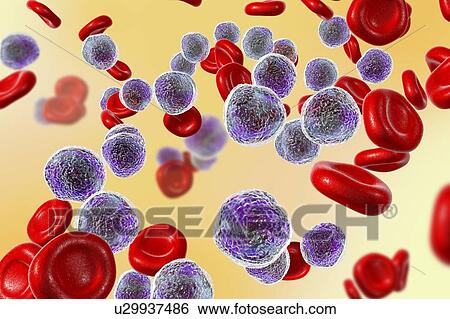 Acute lymphoblastic leukaemia smear, illustration View Large Photo Image Stock Photograph - Acute lymphoblastic leukaemia smear, illustration. Fotosearch
