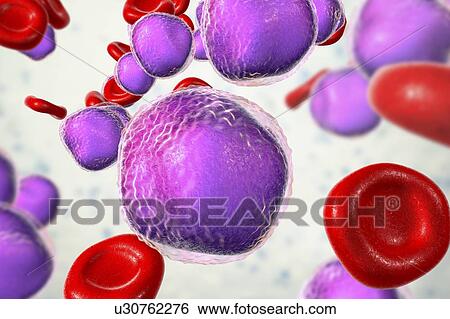 Stock Photograph - Acute lymphoblastic leukaemia smear, illustration. Fotosearch