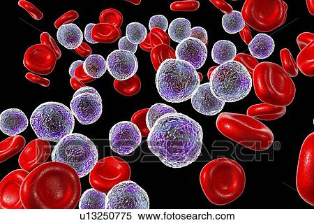 Stock Photography - Acute lymphoblastic leukaemia smear, illustration. Fotosearch