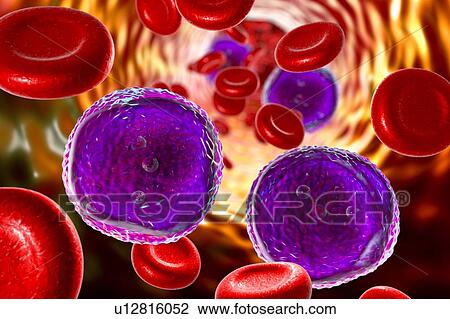 Stock Image - Acute lymphoblastic leukaemia, illustration. Fotosearch