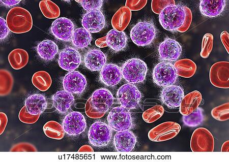 Stock Image - Acute lymphoblastic leukaemia treatment, illustration. Fotosearch