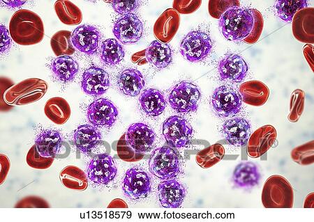 Stock Photo - Acute lymphoblastic leukaemia treatment, illustration. Fotosearch