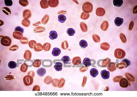 Stock Photograph - Acute lymphoblastic leukaemia, illustration. Fotosearch