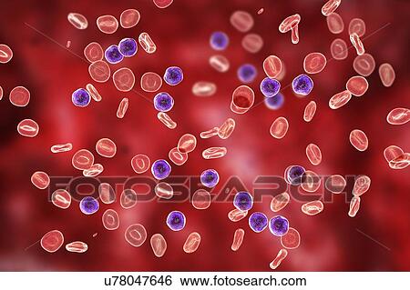 Acute lymphoblastic leukaemia, illustration View Large Photo Image Stock Photograph - Acute lymphoblastic leukaemia, illustration. Fotosearch