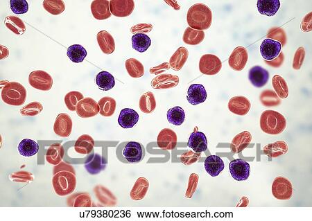 Acute lymphoblastic leukaemia, illustration View Large Photo Image Stock Photograph - Acute lymphoblastic leukaemia, illustration. Fotosearch