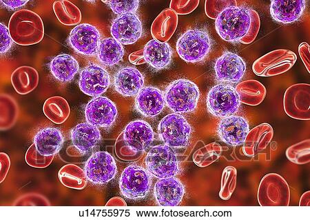 Acute lymphoblastic leukaemia treatment, illustration View Large Photo Image Stock Photography - Acute lymphoblastic leukaemia treatment, illustration. Fotosearch