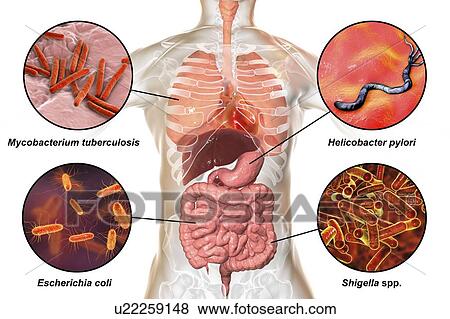 Stock Photo - Bacteria that cause human infections, illustration. Fotosearch