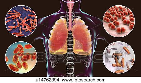 Bacteria that cause lung infections, illustration View Large Photo Image Picture - Bacteria that cause lung infections, illustration. Fotosearch