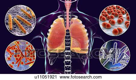 Bacteria that cause lung infections, illustration View Large Photo Image Stock Image - Bacteria that cause lung infections, illustration. Fotosearch