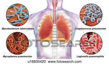 Stock Image - Bacteria that cause lung infections, illustration. Fotosearch