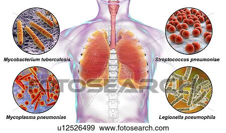 Stock Photo - Bacteria that cause lung infections, illustration. Fotosearch