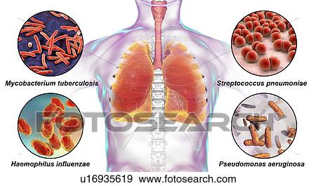 Bacteria that cause lung infections, illustration View Large Photo Image Stock Photo - Bacteria that cause lung infections, illustration. Fotosearch