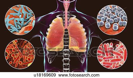 Bacteria that cause lung infections, illustration View Large Photo Image Stock Photo - Bacteria that cause lung infections, illustration. Fotosearch