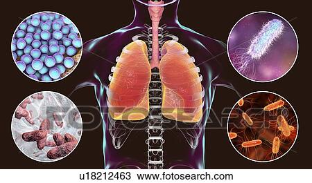 Stock Image - Bacteria that cause nosocomial pneumonia, illustration. Fotosearch