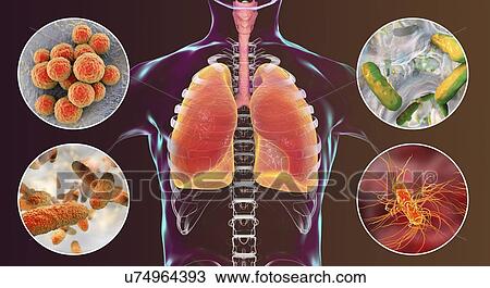 Stock Image - Bacteria that cause nosocomial pneumonia, illustration. Fotosearch
