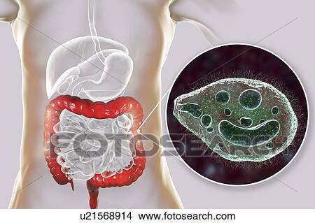 Picture - Balantidiasis, conceptual illustration. Fotosearch