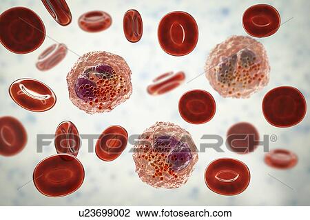 Stock Image - Blood smear with numerous eosinophils, illustration. Fotosearch