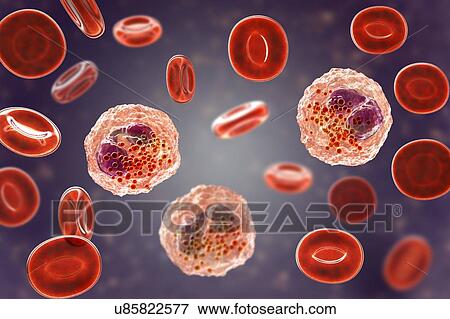Stock Photo - Blood smear with numerous eosinophils, illustration. Fotosearch