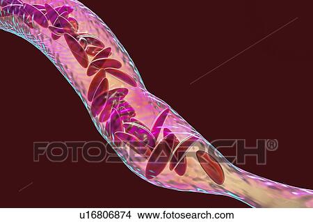 Blood vessel blocked in sickle cell anaemia, illustration View Large Photo Image Picture - Blood vessel blocked in sickle cell anaemia, illustration. Fotosearch