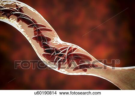 Picture - Blood vessel blocked in sickle cell anaemia, illustration. Fotosearch