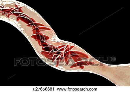 Stock Image - Blood vessel blocked in sickle cell anaemia, illustration. Fotosearch