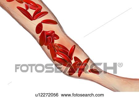 Stock Photograph - Blood vessel blocked in sickle cell anaemia, illustration. Fotosearch