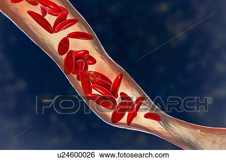 Blood vessel blocked in sickle cell anaemia, illustration View Large Photo Image Stock Photograph - Blood vessel blocked in sickle cell anaemia, illustration. Fotosearch