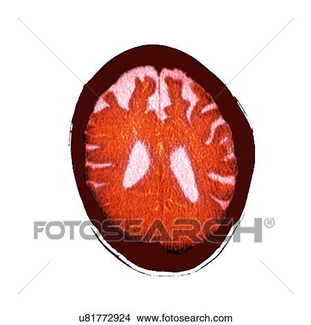 Brain in dementia, CT scan View Large Photo Image Picture - Brain in dementia, CT scan. Fotosearch