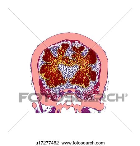 Brain in dementia, CT scan View Large Photo Image Stock Image - Brain in dementia, CT scan. Fotosearch