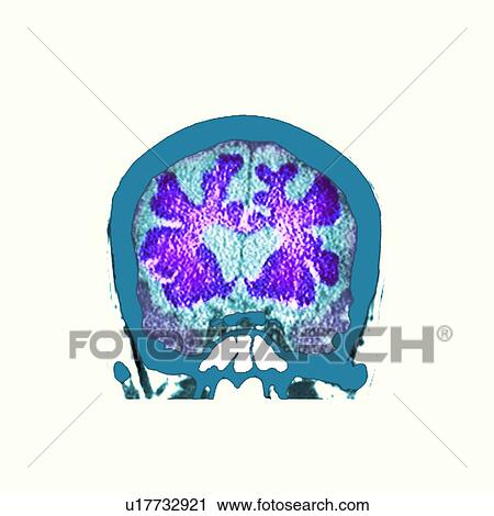 Brain in dementia, CT scan View Large Photo Image Stock Image - Brain in dementia, CT scan. Fotosearch