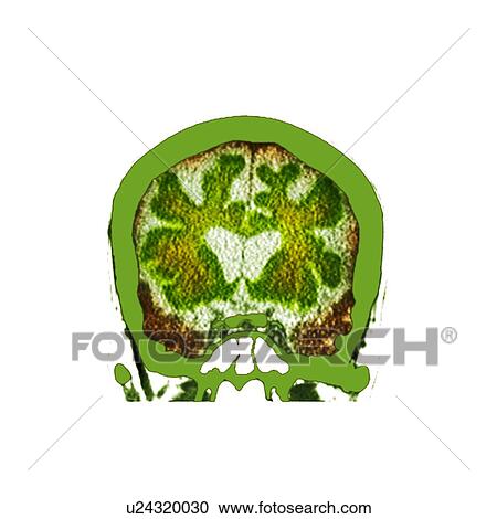 Stock Image - Brain in dementia, CT scan. Fotosearch