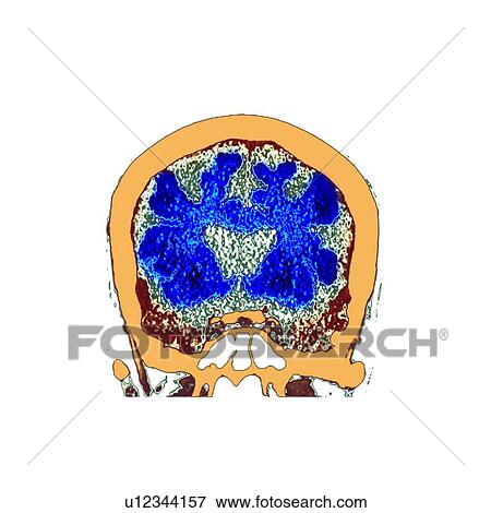 Brain in dementia, CT scan View Large Photo Image Stock Photo - Brain in dementia, CT scan. Fotosearch