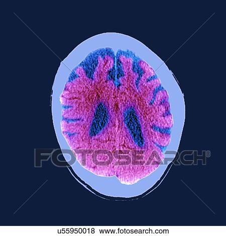 Stock Photo - Brain in dementia, CT scan. Fotosearch