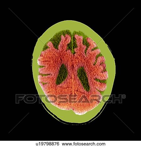 Stock Photograph - Brain in dementia, CT scan. Fotosearch