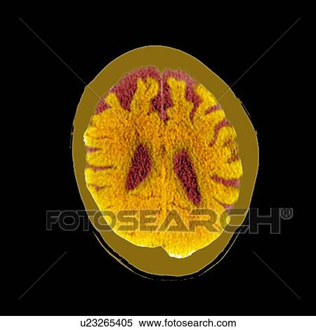 Brain in dementia, CT scan View Large Photo Image Stock Photography - Brain in dementia, CT scan. Fotosearch