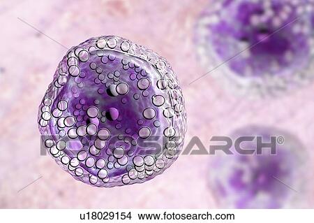 Burkitt's lymphoma cells, illustration View Large Photo Image Picture - Burkitt's lymphoma cells, illustration. Fotosearch