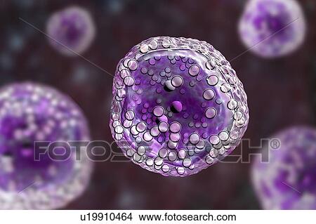 Picture - Burkitt's lymphoma cells, illustration. Fotosearch