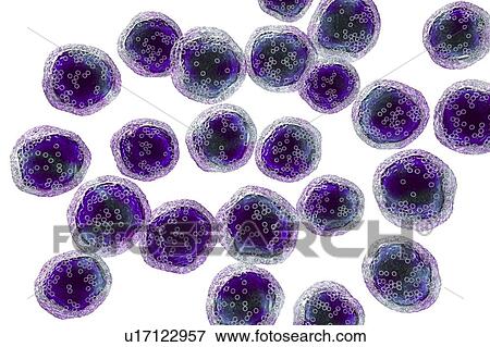 Burkitt's lymphoma cells, illustration View Large Photo Image Stock Photo - Burkitt's lymphoma cells, illustration. Fotosearch