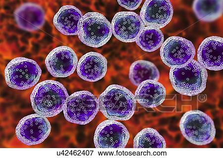 Burkitt's lymphoma cells, illustration View Large Photo Image Stock Photo - Burkitt's lymphoma cells, illustration. Fotosearch