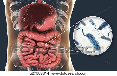 Picture - Cholera infection, illustration. Fotosearch