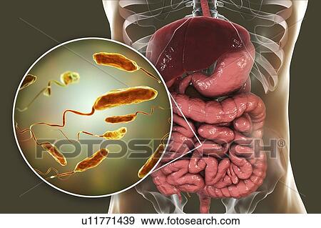 Cholera infection, illustration View Large Photo Image Stock Photo - Cholera infection, illustration. Fotosearch