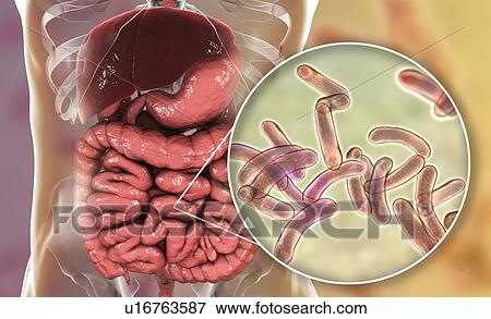 Cholera infection, illustration View Large Photo Image Stock Photo - Cholera infection, illustration. Fotosearch
