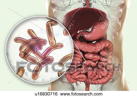 Stock Photograph - Cholera infection, illustration. Fotosearch