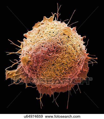 Colorectal cancer cell. Coloured scanning electron micrograph (SEM) of a cancer cell from the human colon (large intestine). Cancer of the colon is also known as colorectal cancer. Symptoms include rectal bleeding and abdominal pain. Treatment is with... View Large Photo Image Stock Photo - Colorectal cancer cell. Coloured scanning electron micrograph (SEM) of a cancer cell from the human colon (large intestine). Cancer of the colon is also known as colorectal cancer. Symptoms include rectal bleeding and abdominal pain. Treatment is with.... Fotosearch