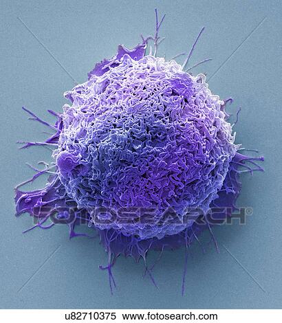 Stock Photography - Colorectal cancer cell. Coloured scanning electron micrograph (SEM) of a cancer cell from the human colon (large intestine). Cancer of the colon is also known as colorectal cancer. Symptoms include rectal bleeding and abdominal pain. Treatment is with.... Fotosearch